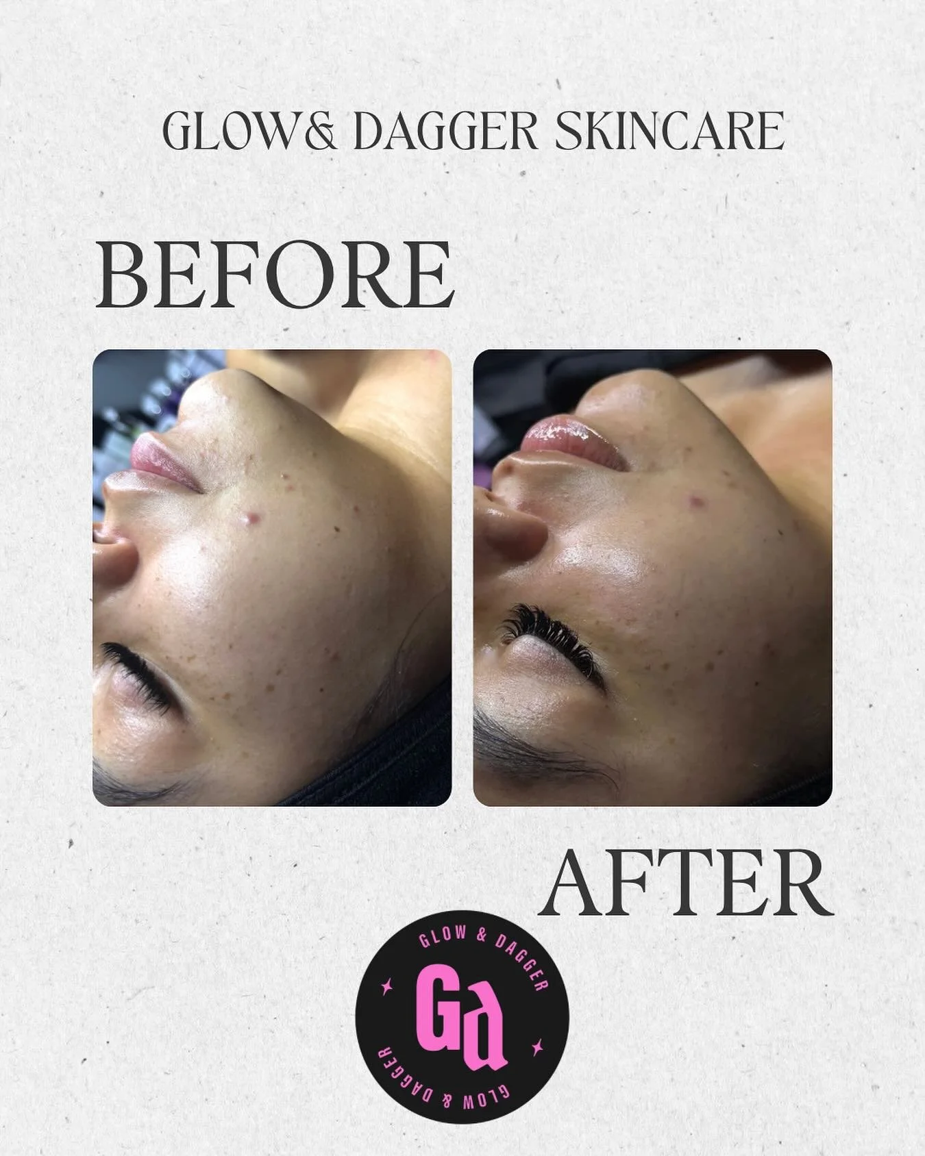 Here&rsquo;s a before + after from a 60 min customized facial✨🧖&zwj;♀️

My client came in wanting help with texture and congestion, so I built her treatment around gentle exfoliation, rebalancing oil levels, and calming support.  Here&rsquo;s what h