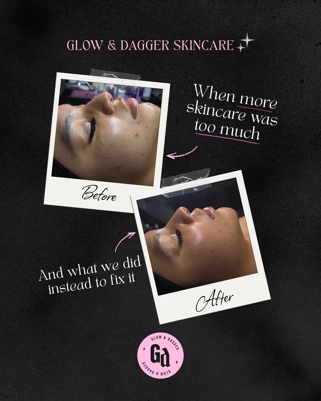 This transformation is proof that more skincare doesn&rsquo;t always mean better skin 👀

In this case, the issue wasn&rsquo;t a lack of effort. It was too much of it.

This client has combination, congestion-prone skin and already had a solid routin