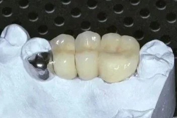 Dental model with four artificial teeth and one metal crown on the leftmost tooth