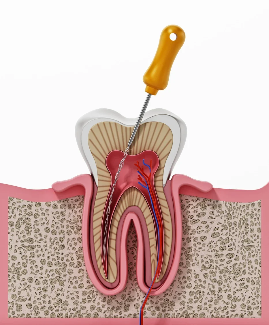 Cross-section of a tooth undergoing root canal treatment with a dental file inside the root canal.