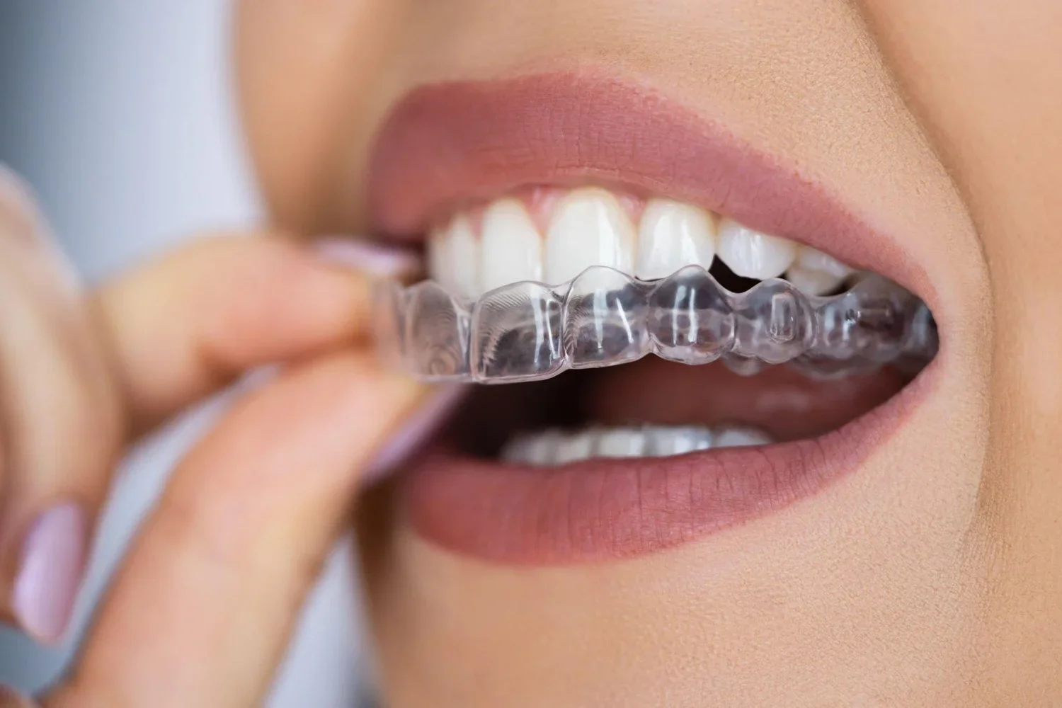 Close-up of a person smiling and applying a clear dental night guard or retainer to their teeth.
