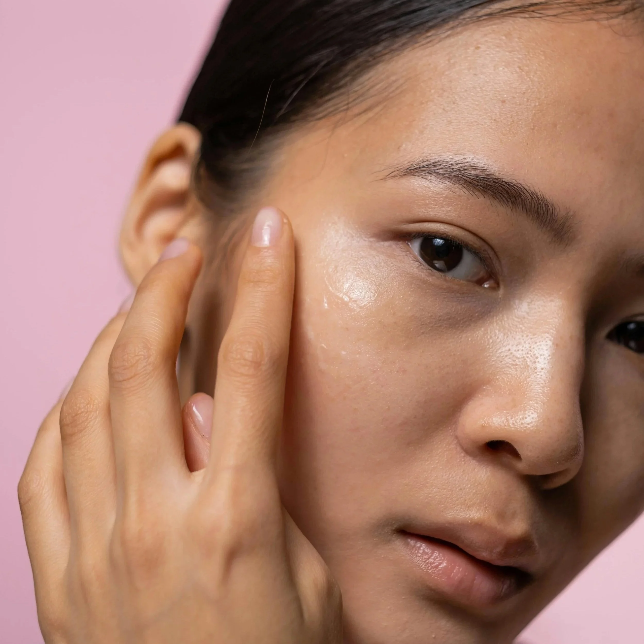 Acne Scars: Why They Happen, What Actually Works, and How to Improve Them