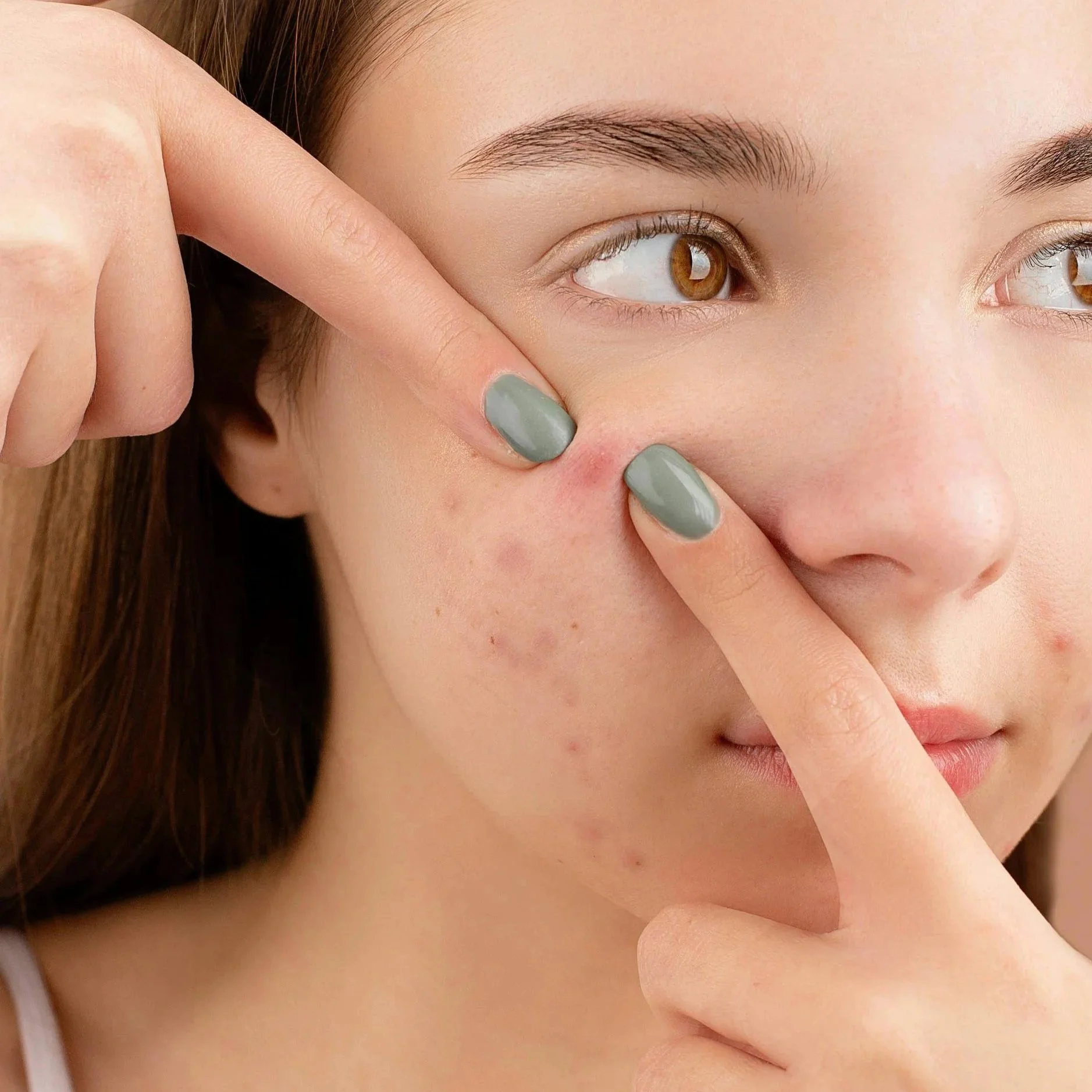 Blemish-Prone Skin: What It Means, Why It Happens &amp; What Can Help