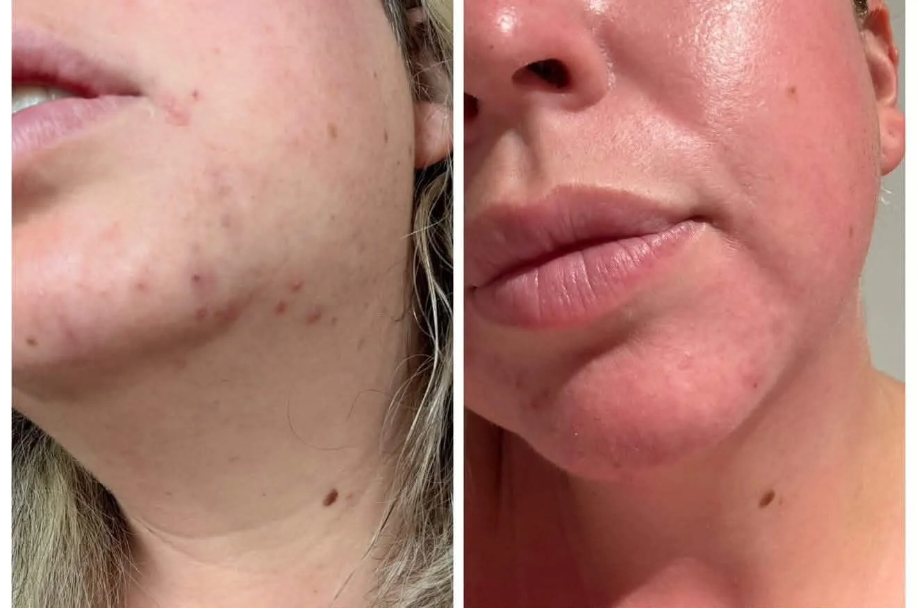 Rosacea and Facial Redness: What's Actually Going On With Your Skin?