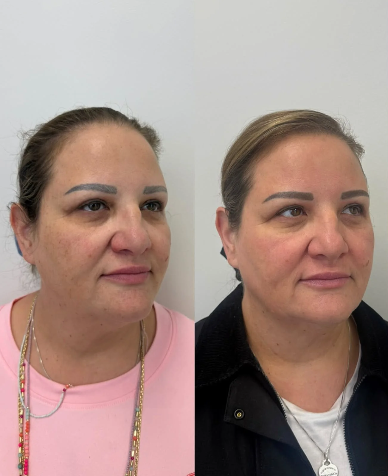 The Science Behind BBL®: Can Light Therapy Help Skin Behave More Youthfully?
