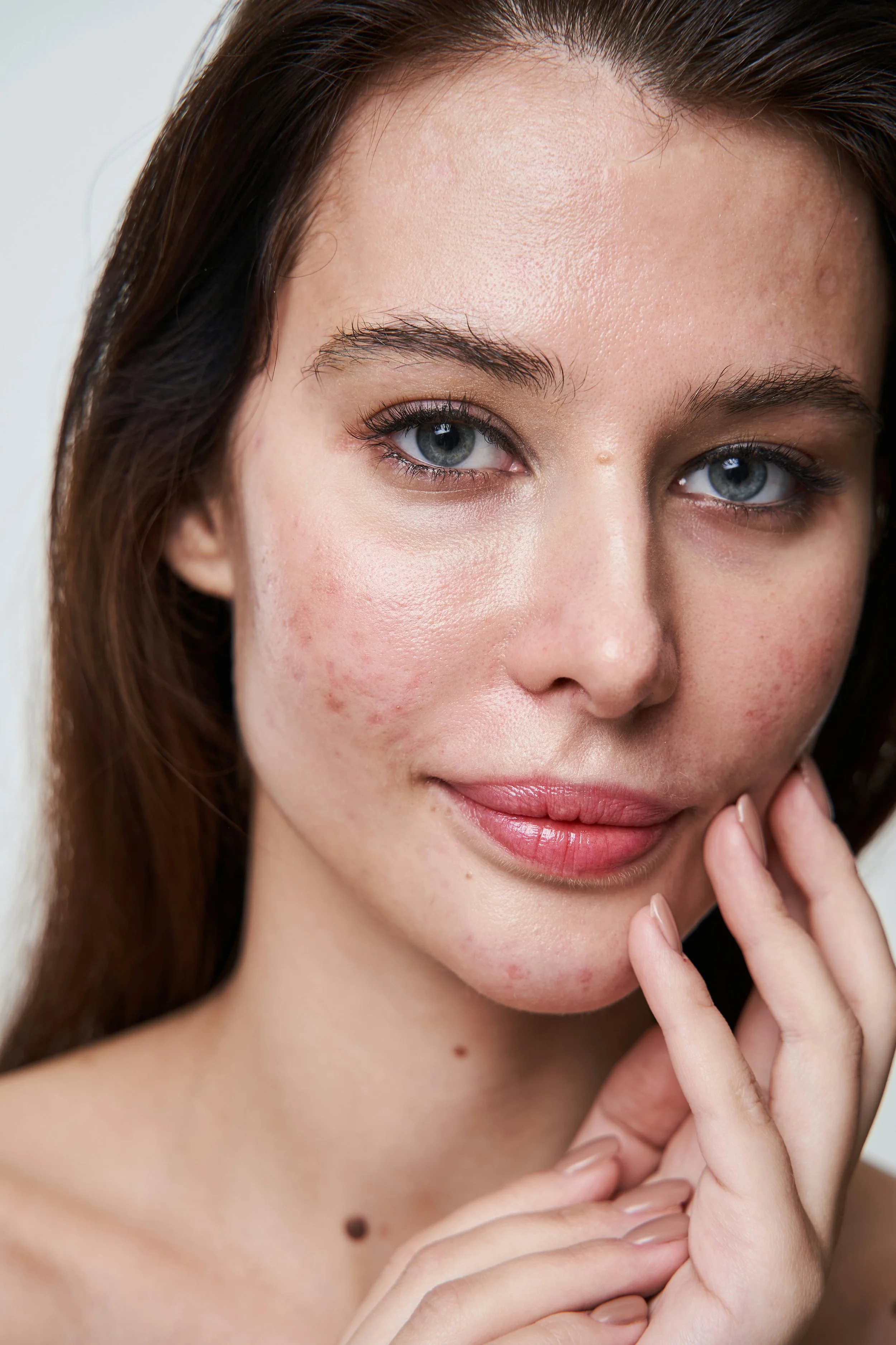 Blemish-Prone Skin: What It Means, Why It Happens &amp; What Can Help
