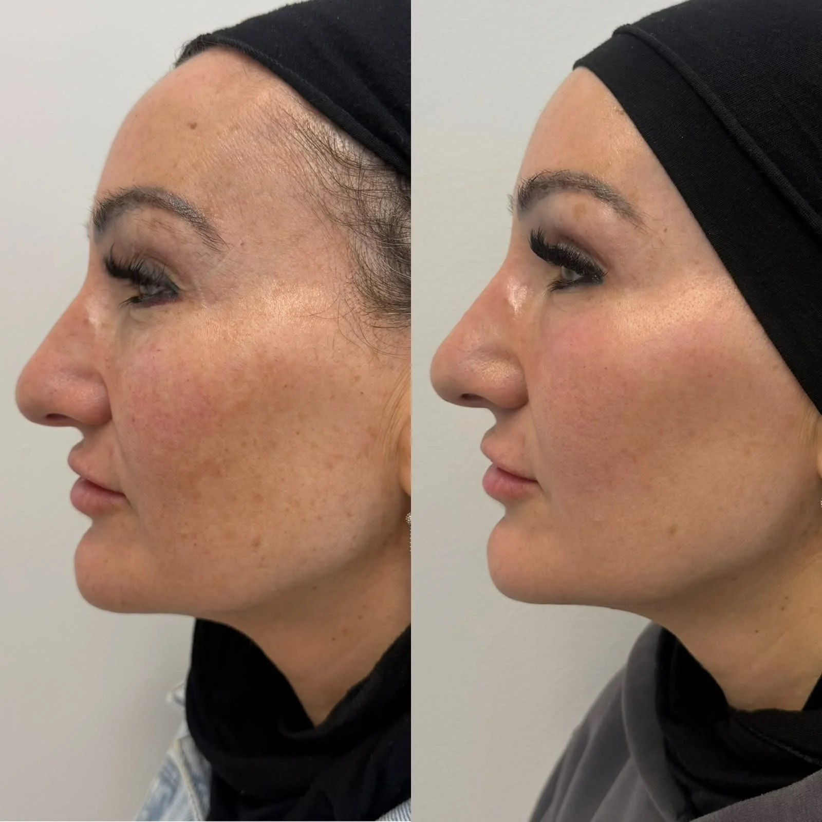 PigmentationBeforeandAfter