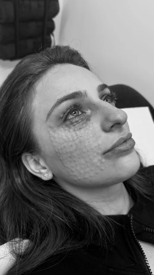 Rejuran Salmon DNA Treatment Sydney
