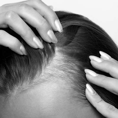 Hair Loss Treatment Sydney
