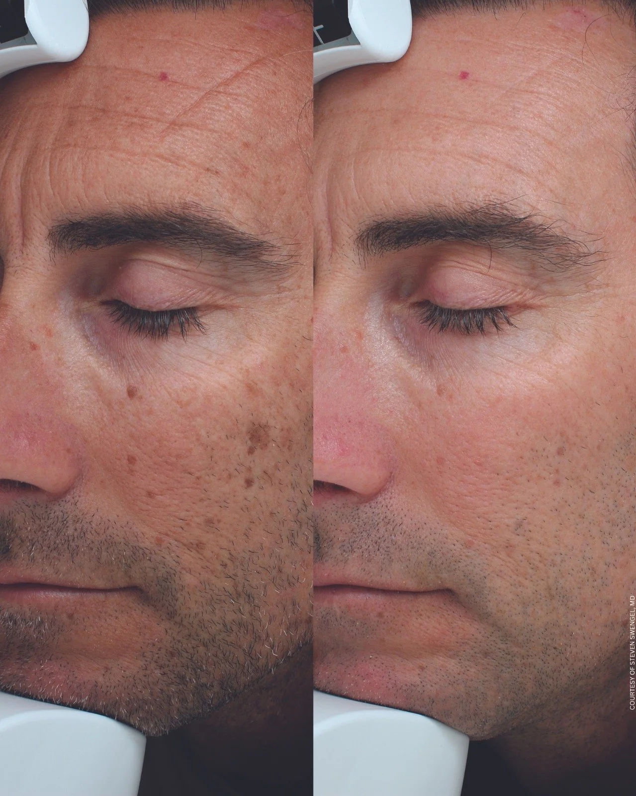 BBL Heroic and Moxi Laser