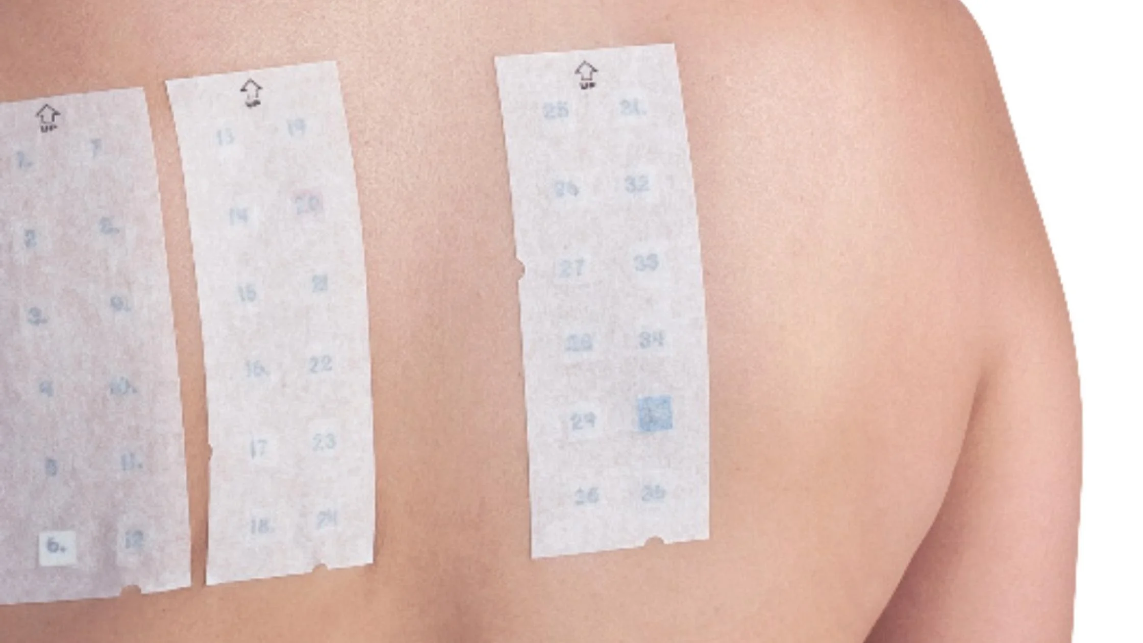 Dermatology patch testing on the skin to diagnose allergic contact dermatitis from skincare or cosmetic products
