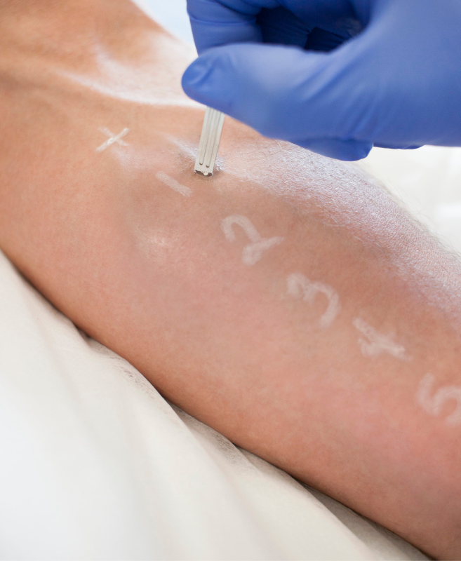 Mans arm on a pillow getting patch testing