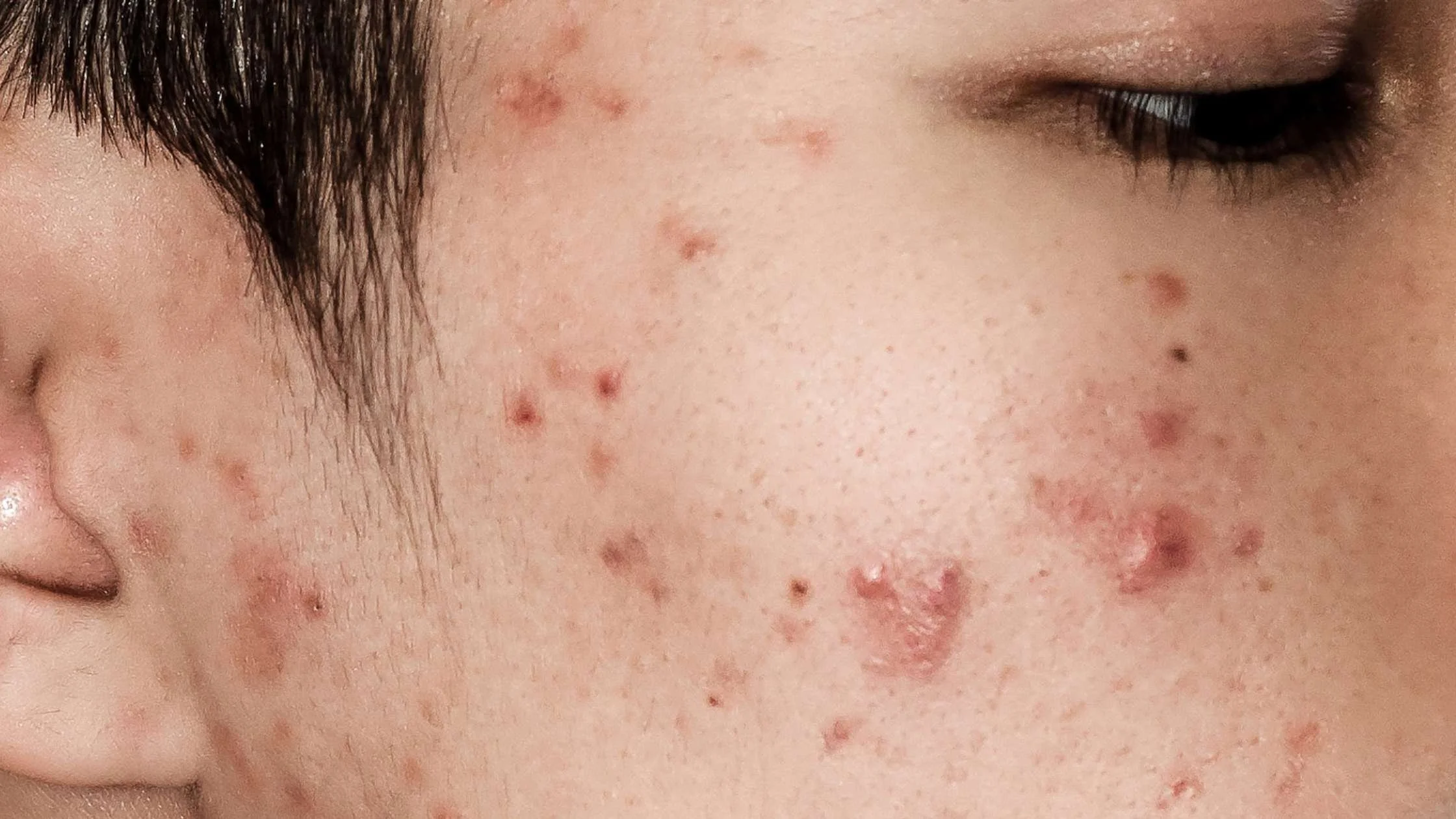 Inflamed facial skin condition with redness and irritation similar to eczema or dermatitis