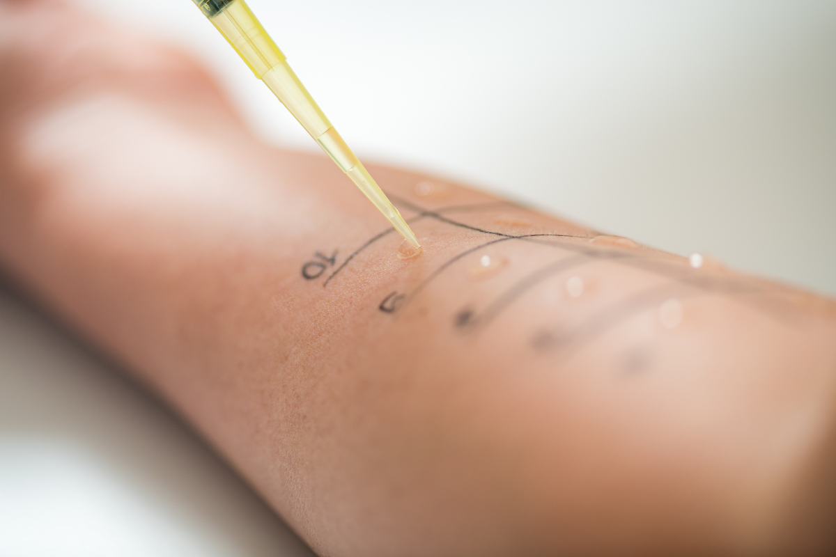 Womans arm with patch testing grid drawn on