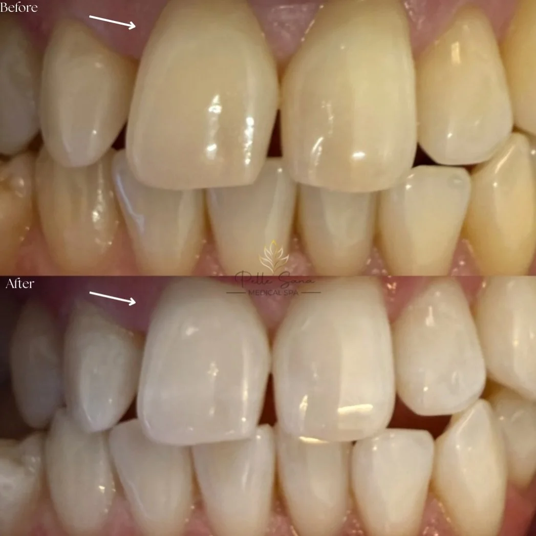 Bright smiles season is here 😁✨

Holiday parties, family pics, date nights, all start with a confident smile. Our professional teeth whitening is on promo right now and yes, we have availability this weekend.

🎁 Gift cards available, perfect stocki