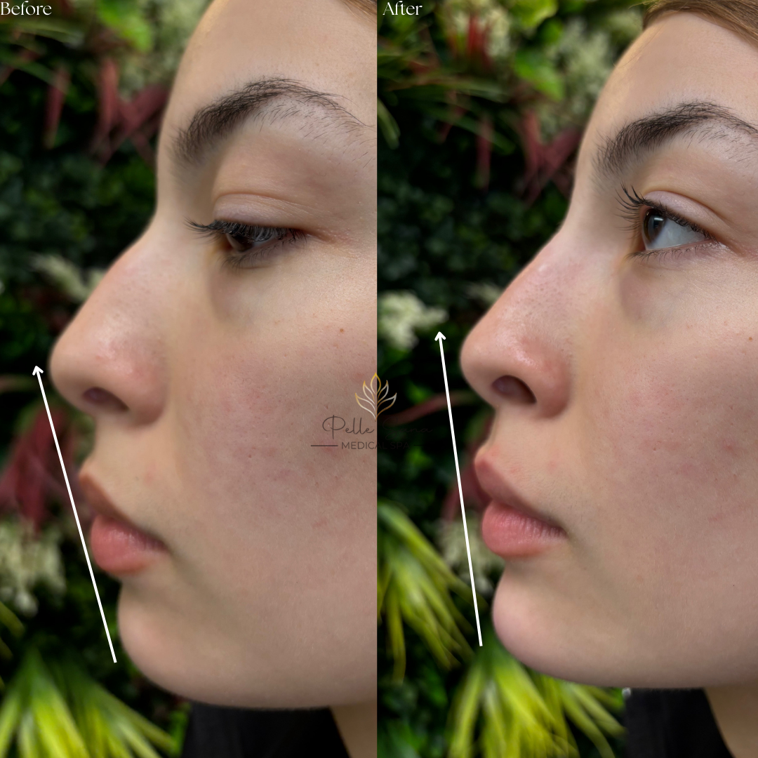 Liquid Rhinoplasty