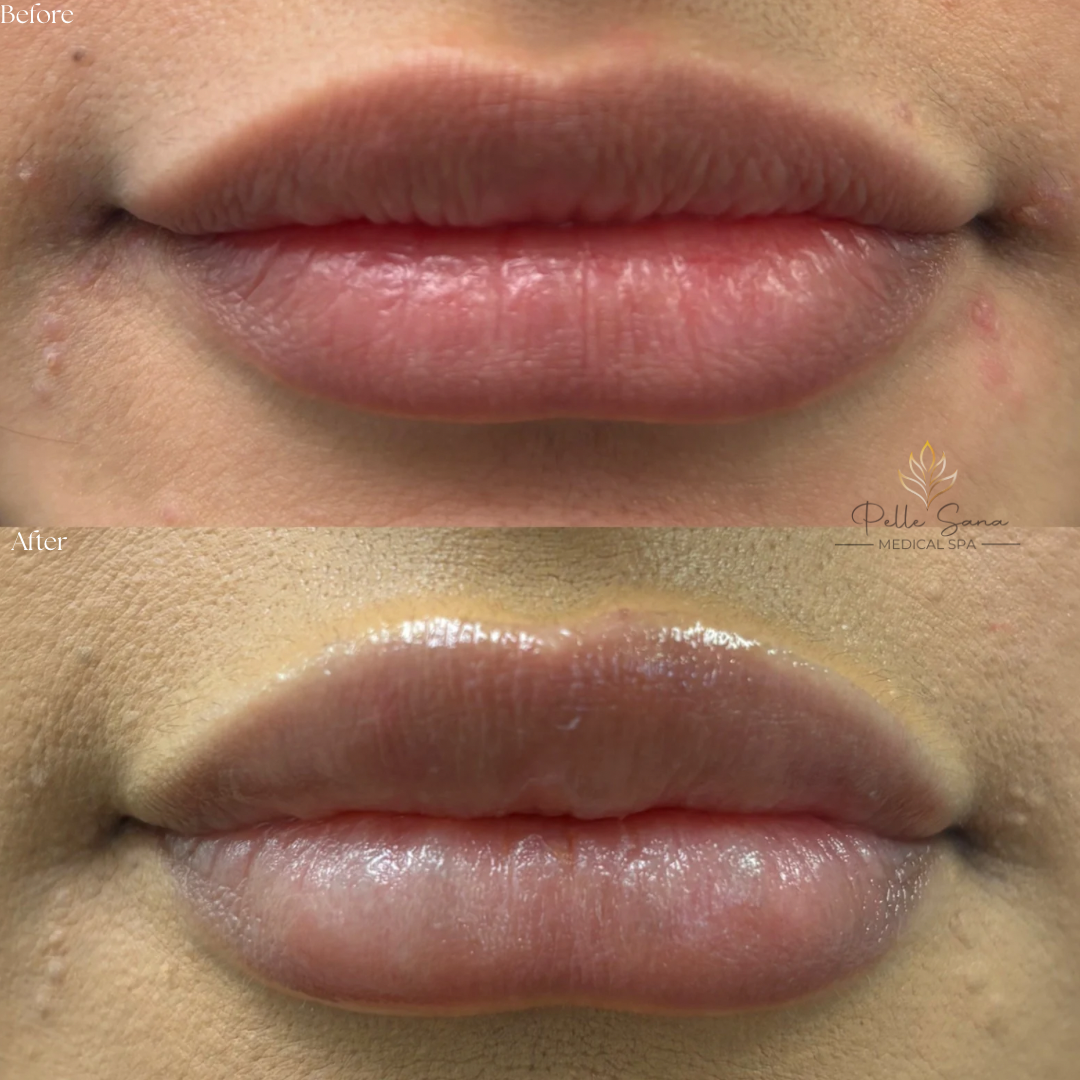 Lip Injections