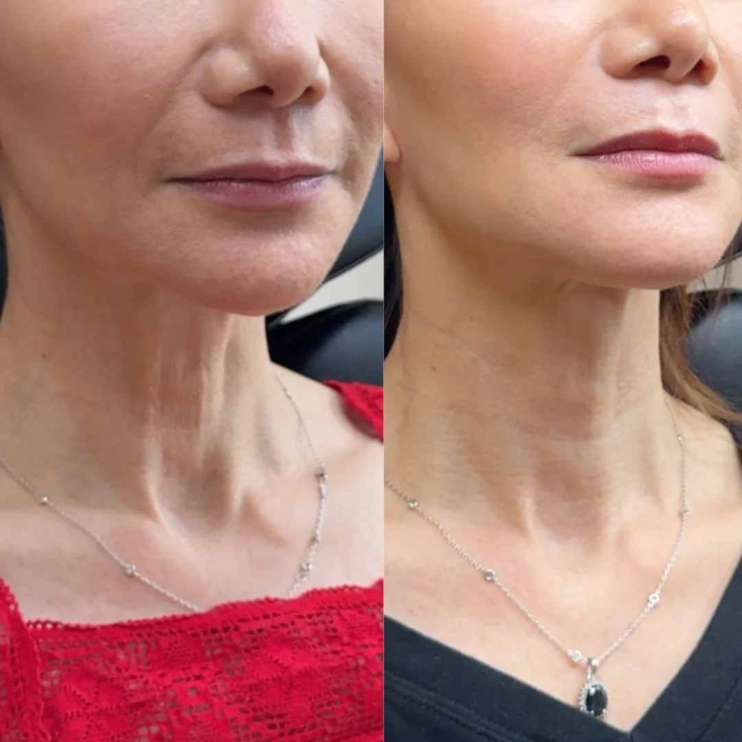 nefertiti-botox-lift-boston