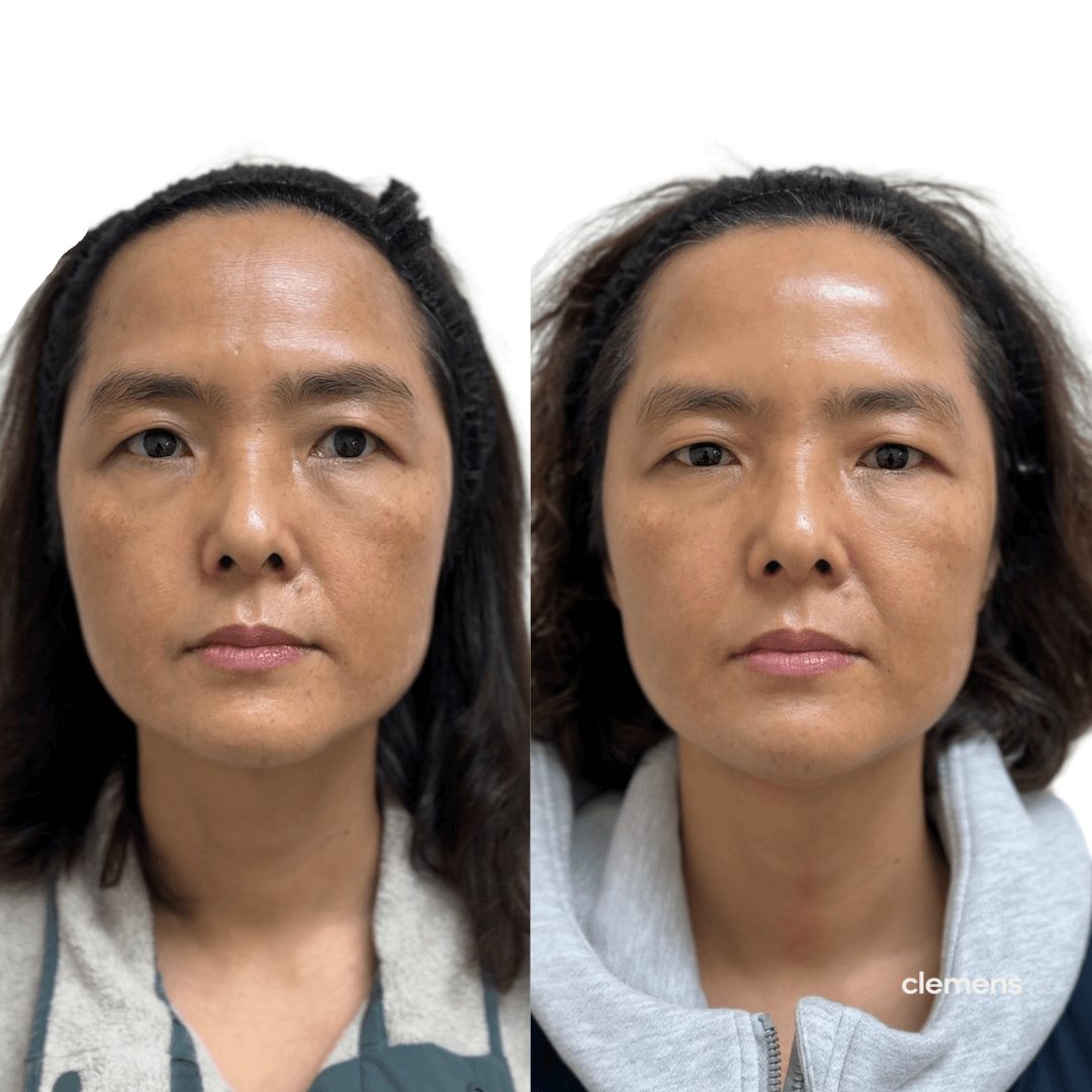 Sculptra and forehead Dysport