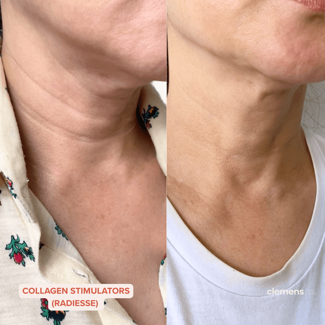 Before and after results using Radiesse for neck lines and folds and neck sagging or tech neck. Treated at Clemens Face + Body in Brookline, Boston.