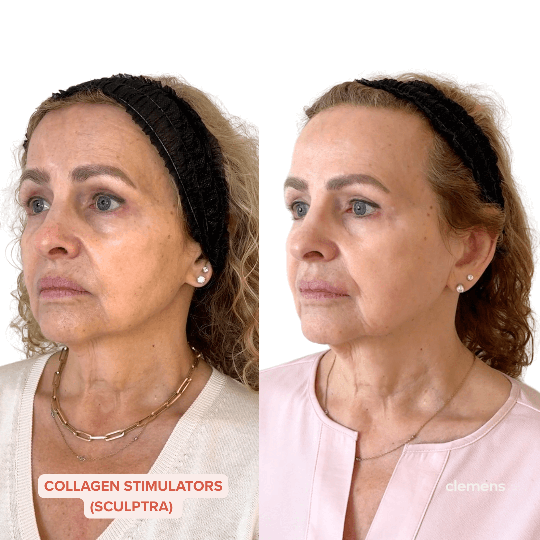Side-by-side comparison of a woman before and after skincare treatment, showing improved skin texture and tone.