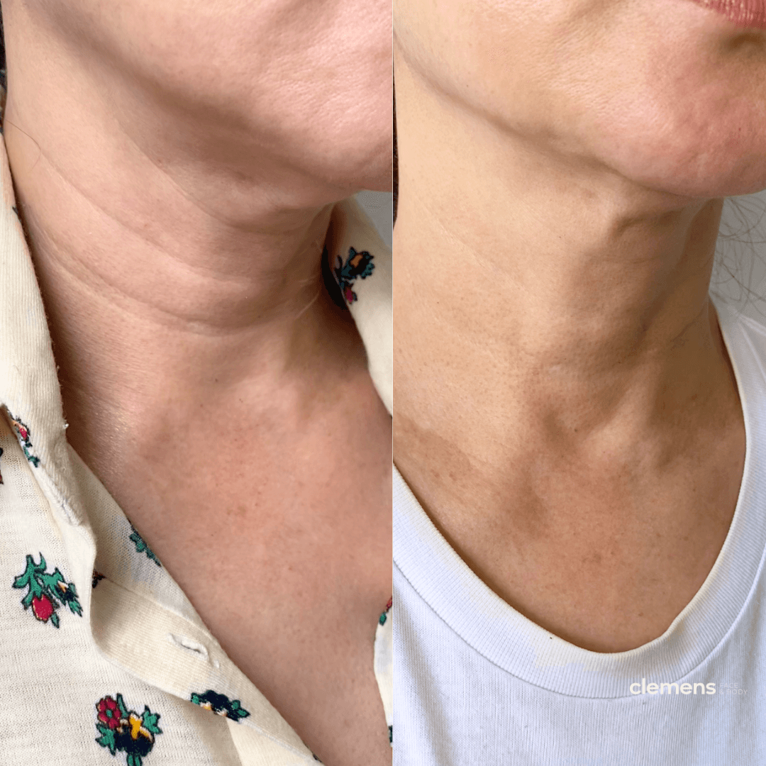 Firming and tightening of the neck with Radiesse