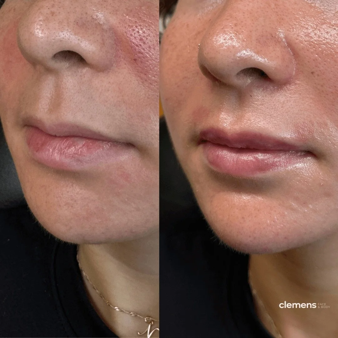 Side by side comparison of fuller lips and correcting lip deformity after lip filler treatment