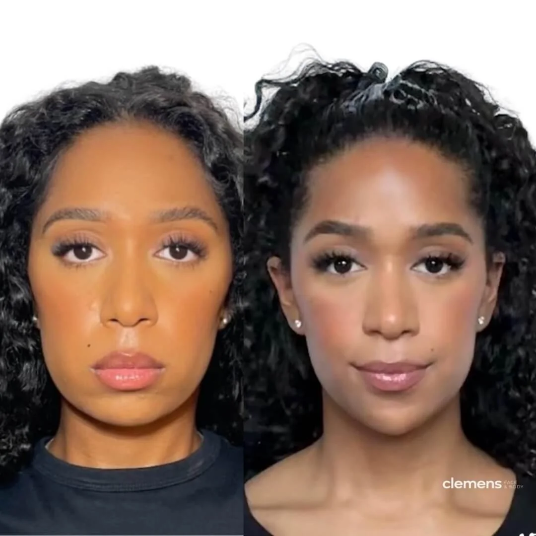 Chin and jawline filler (lower facial balancing)
