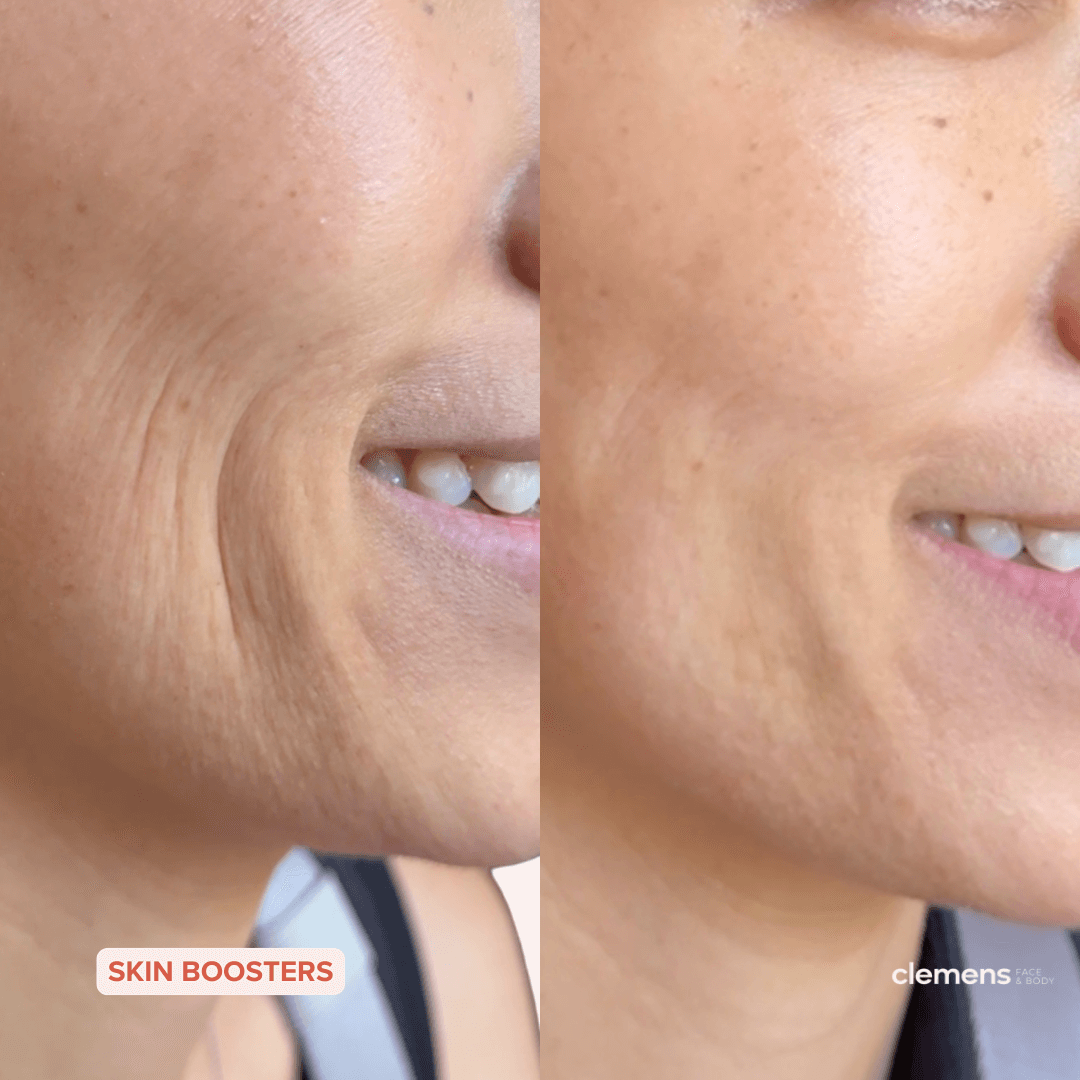 Close-up comparison of a woman's cheek showing skin improving from wrinkles and uneven texture on the left to smooth, clear skin on the right after using skin boosters.