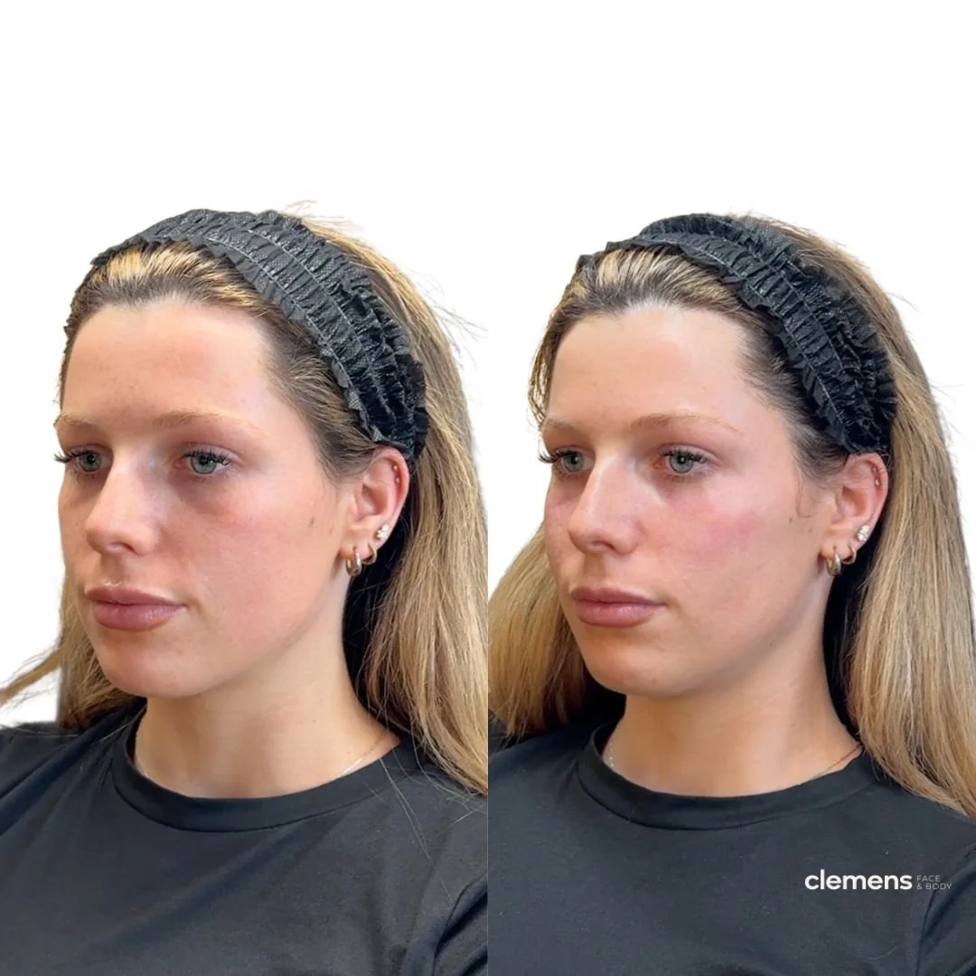 Treatment: Under eye filler 