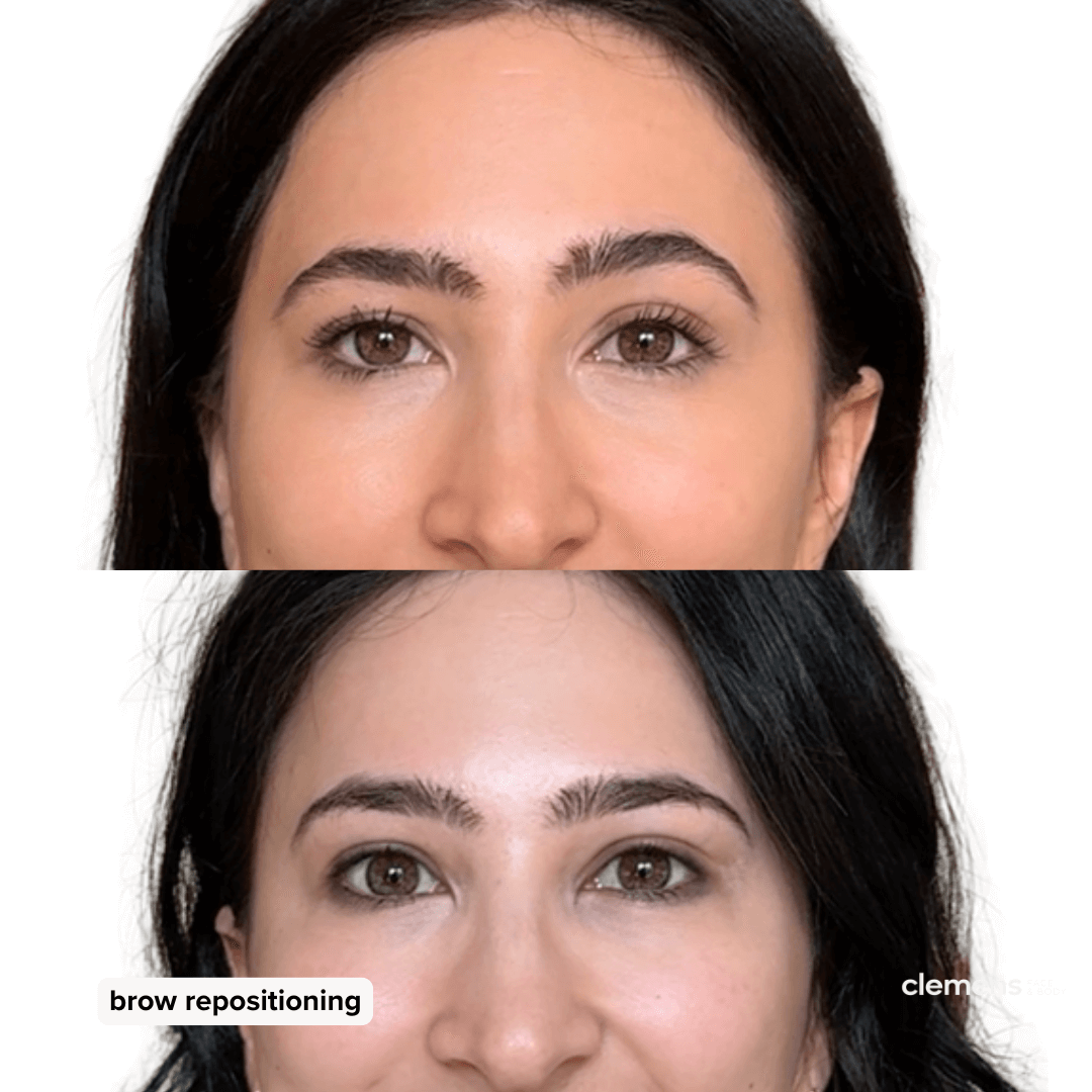 Side by side comparison of a young woman with uneven eyebrows in the first photo and more symmetrical eyebrows in the second photo