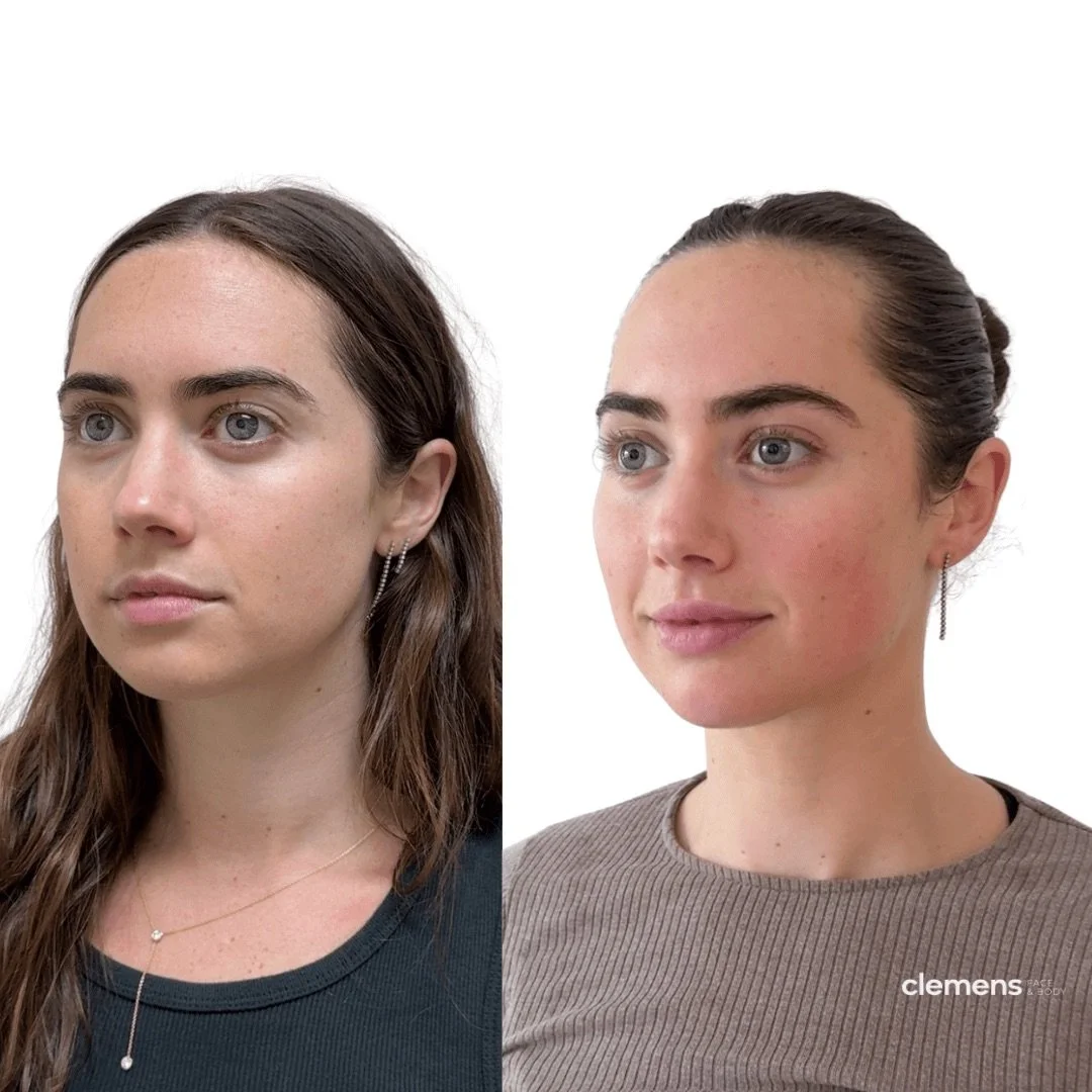 Enhancement you can't quite place. Cheek and chin filler, soft lip filler, and wrinkle relaxers restored early volume loss and preserved her natural features.