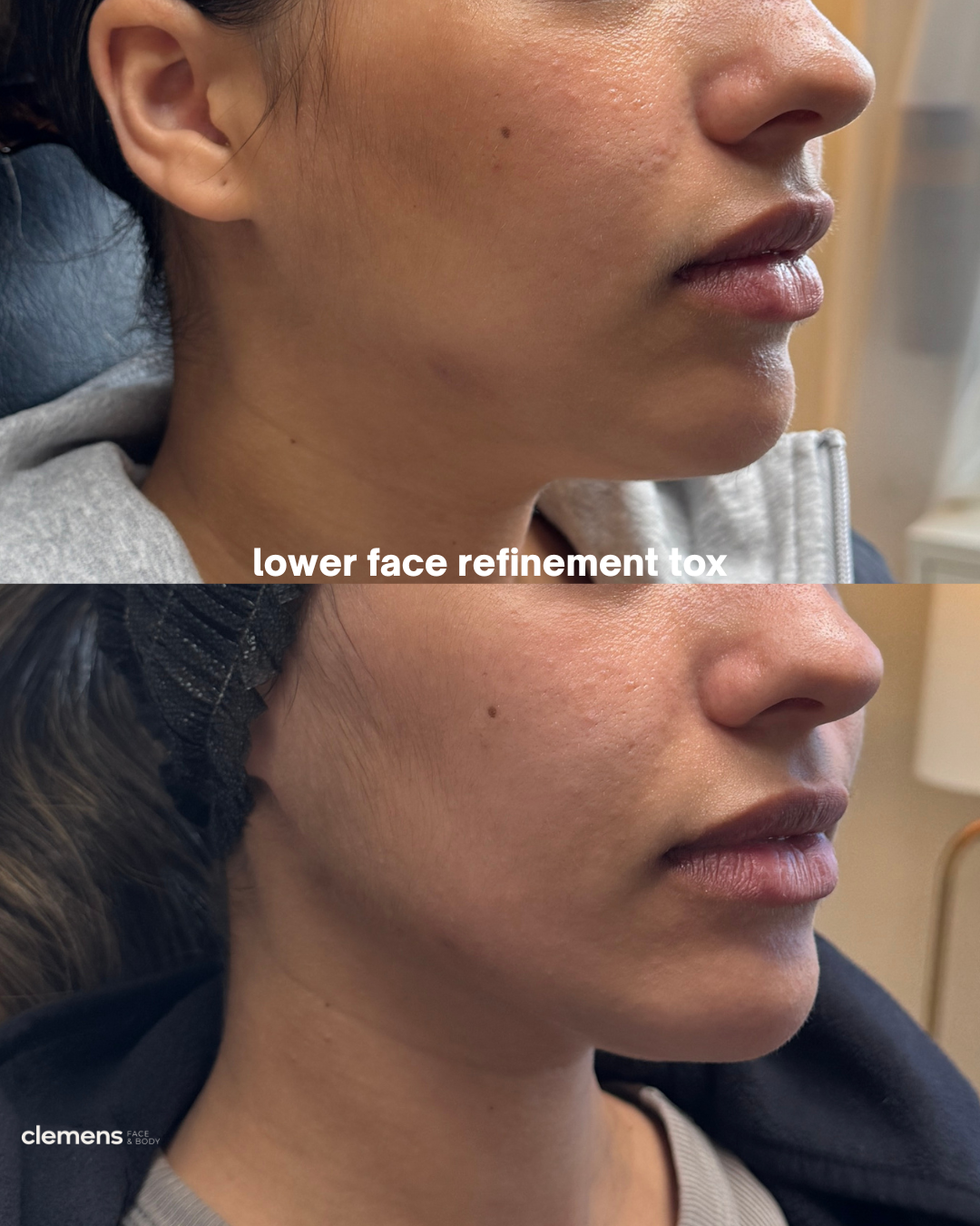 Side-by-side comparison of a woman's lower face before and after lower face refinement toxin treatment, showing smoother skin in the after image.