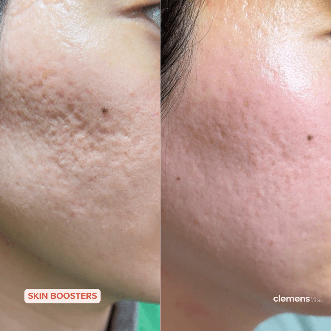 Side by side comparison of a cheeks showing improvement in pitted acne scars