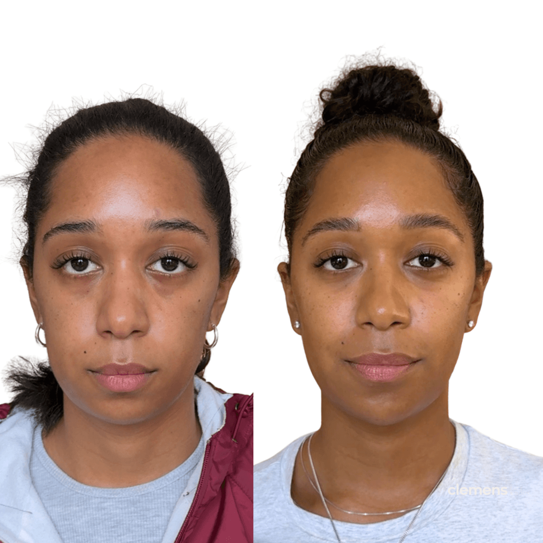 Full facial balancing with under-eye, mid-face, and lower-face fillers