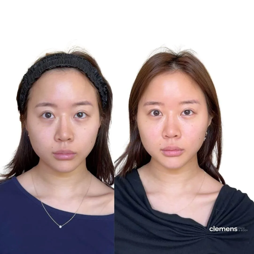 Facial balancing (mid-face and under-eyes), forehead Dysport, and lower face refinement with Dysport