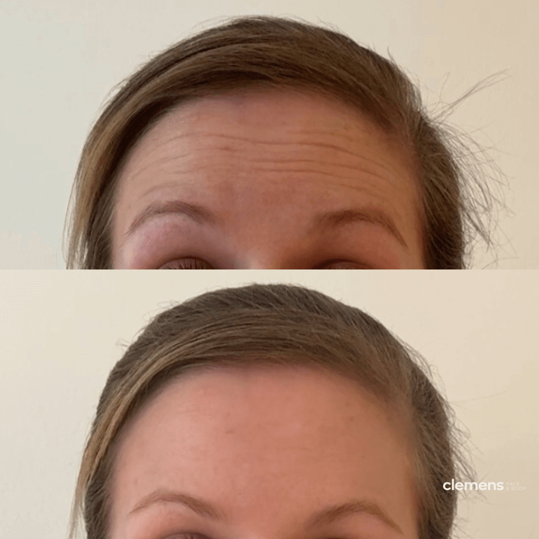 Side by side comparison of erased forehead wrinkles after receiving Botox