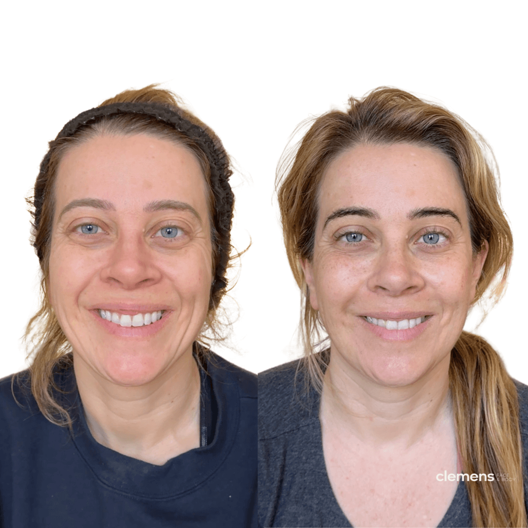 Before and after facial balancing treatment using dermal fillers, wrinkle relaxers, and skin boosters in Boston. Subtle, natural-looking rejuvenation in a female patient.