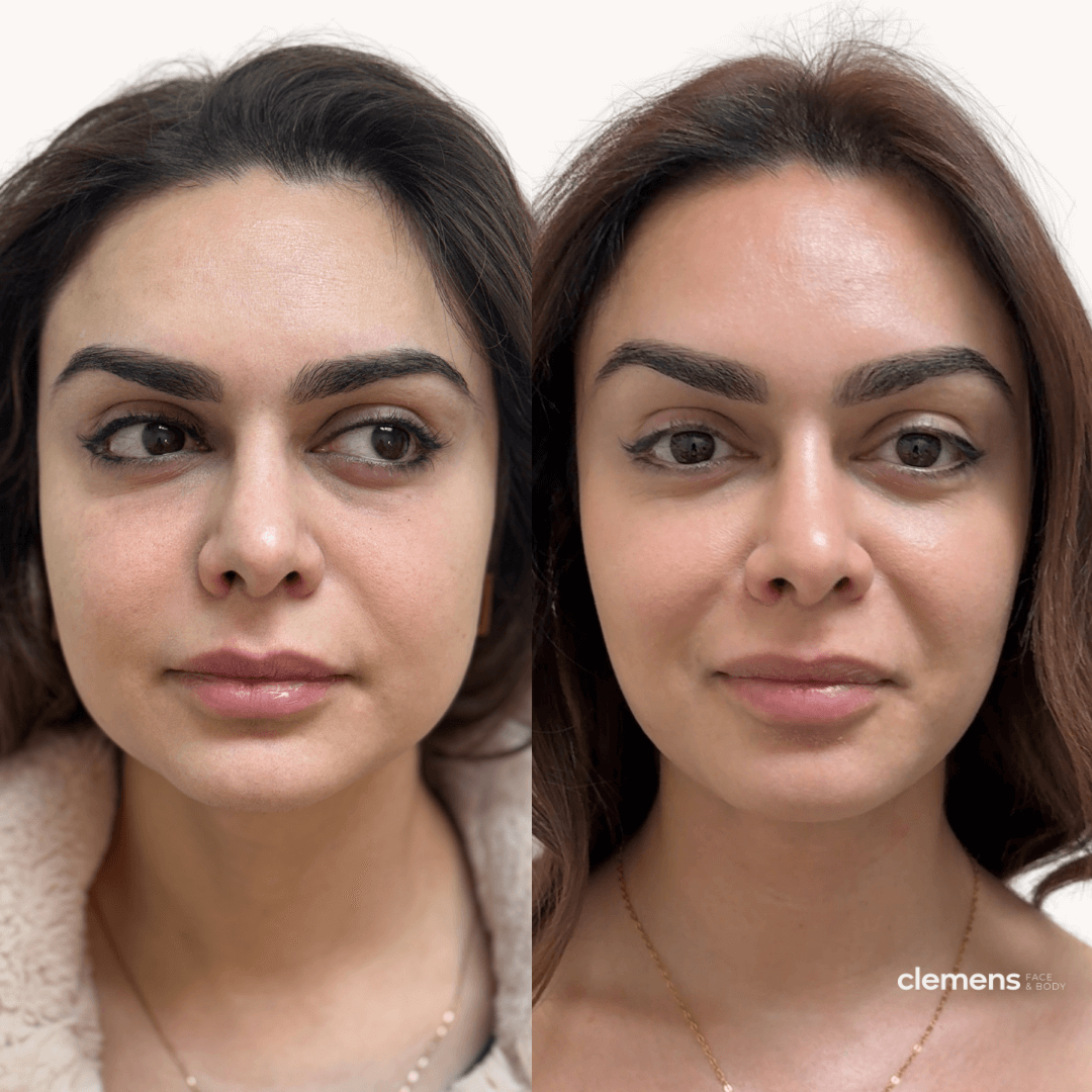 Full facial balancing, forehead and jaw slimming Dysport, and Sculptra