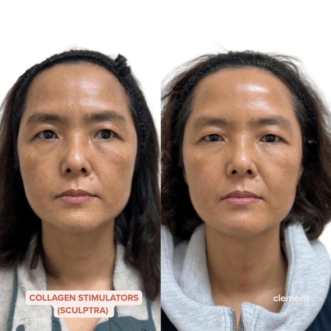 Side-by-side comparison of a woman before and after skincare treatment, showing improved skin texture and complexion.