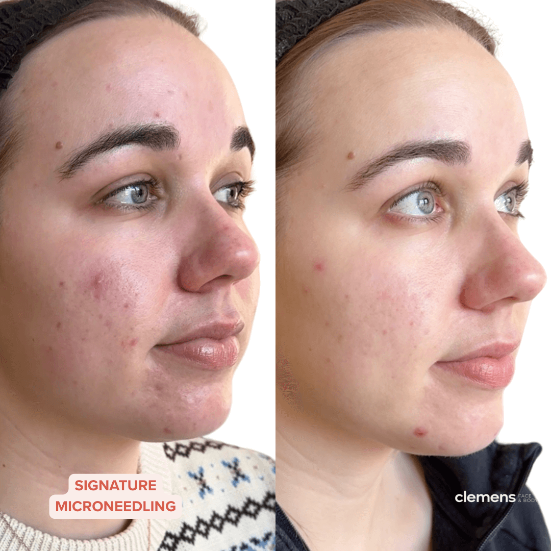 Side-by-side comparison of a woman's face before and after acne treatment, showing clear skin and reduced blemishes in the after image.