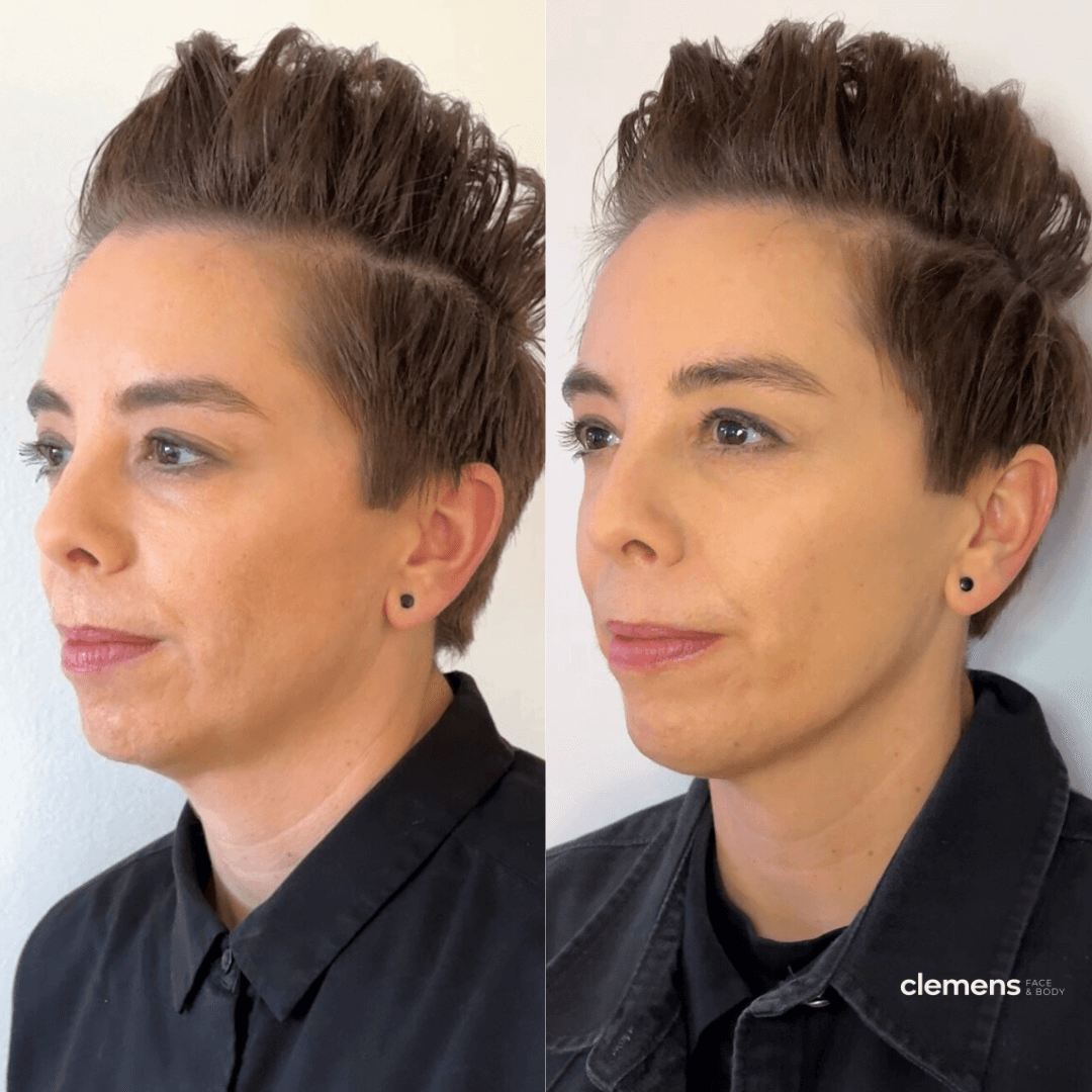 before-and-after-jawline-filler-boston.png.png