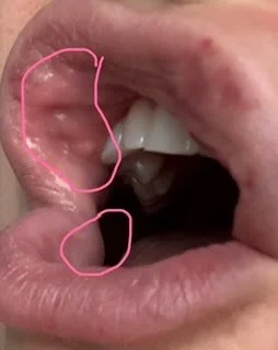 Image of a mouth open with small lumps on the inside after lip filler