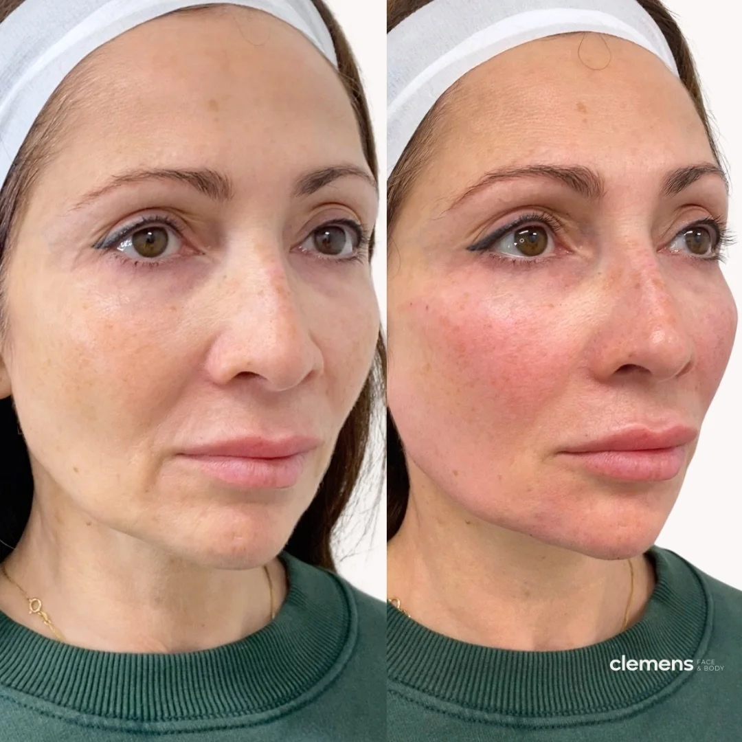 Defying gravity, delaying surgery. Sagging jowls and a softening jawline don't have to mean surgery. Filler through the cheek, chin, and jaw gave her a natural lift.