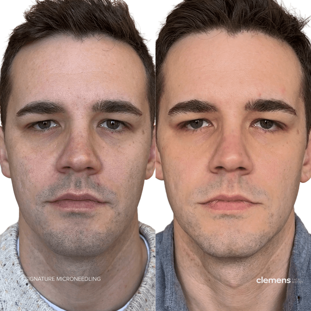 Comparison of a man's face before and after microneedling treatment, showing improved skin texture and appearance.
