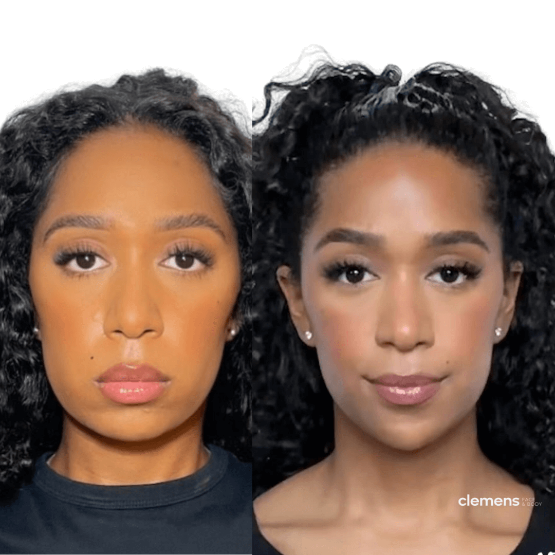 before-and-after-chin-and-jawline-filler-boston-sl copy 2 compressed.png