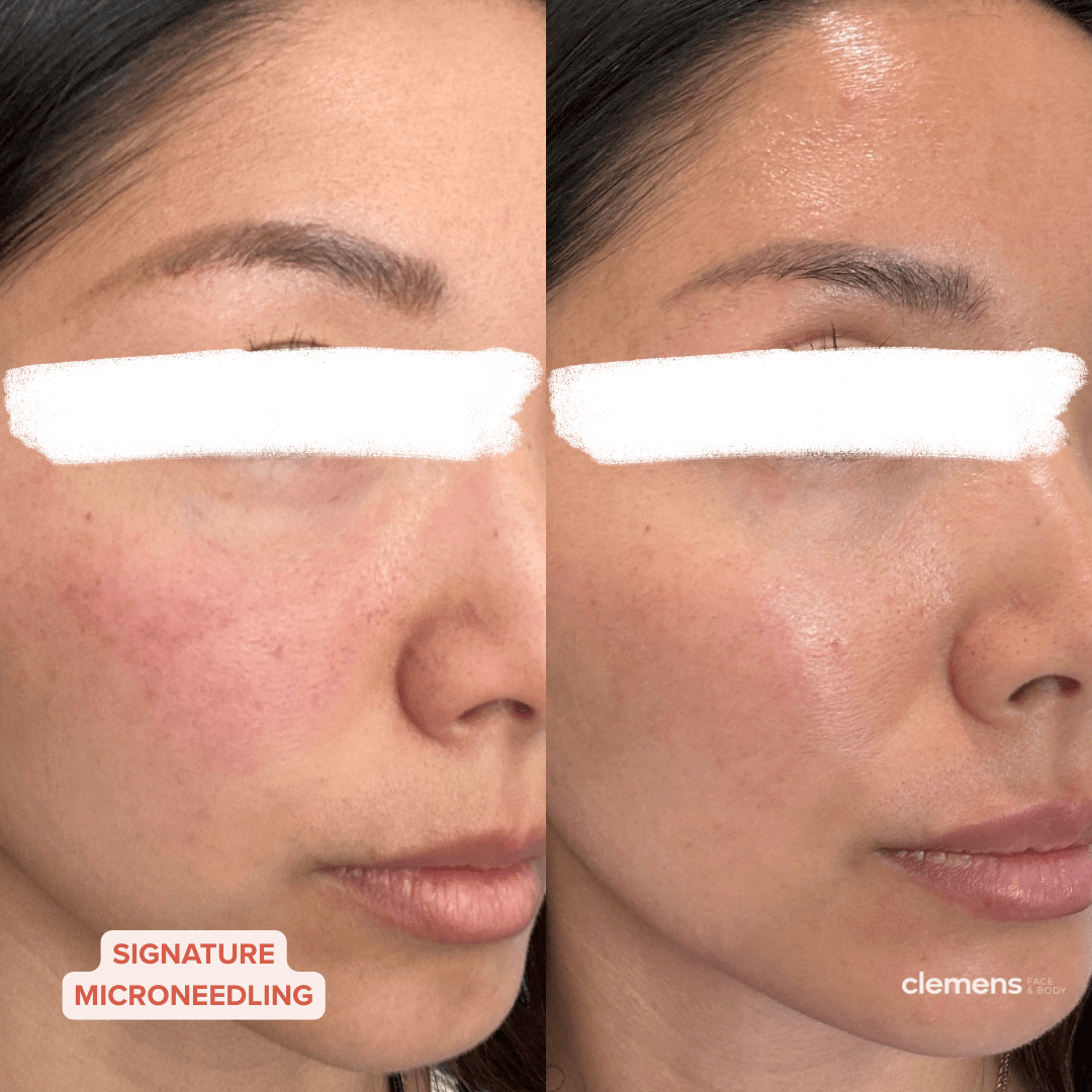 Before and after close-up of a woman's face showing improved skin texture and reduced redness following signature microneedling treatment.