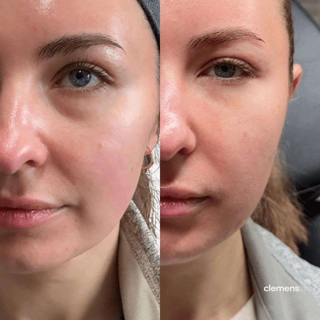 Side by side comparison of a woman with improved under eye bags and dark circles after filler treatment