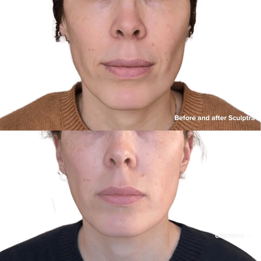 Side-by-side comparison of a woman's face before and after cosmetic Sculptra, showing reduced wrinkles and smoother skin.