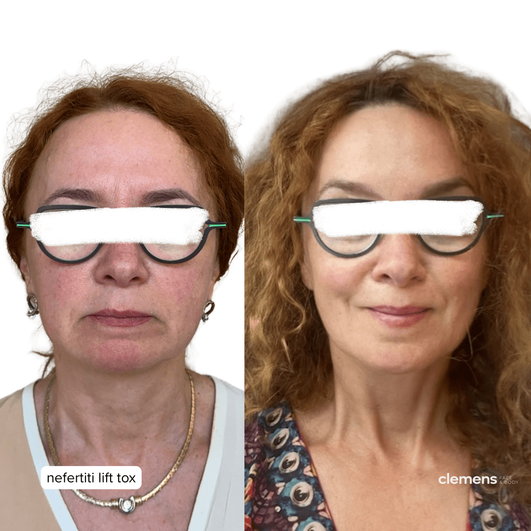 Before and after images of a woman who received a nefertiti lift to reduce wrinkles and enhance facial features, showing noticeable improvement in skin smoothness and facial contours.